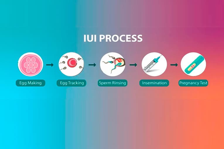 Intrauterine insemination (IUI) — gallery image 5